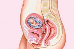 Chuyên gia giải đáp: phá thai bằng thuốc có làm mỏng tử cung không?