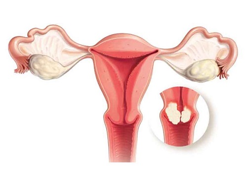 Dính tử cung sau khi nạo hút thai không an toàn