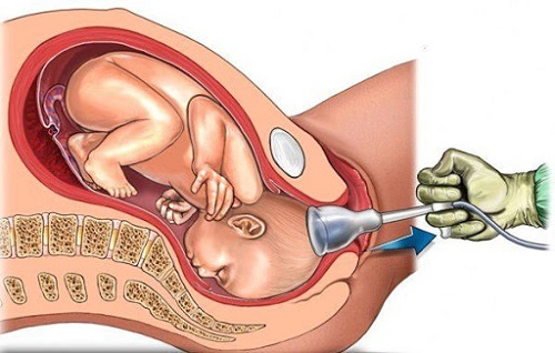Hút thai 5 tuần tuổi hay phá thai bằng thuốc tốt hơn