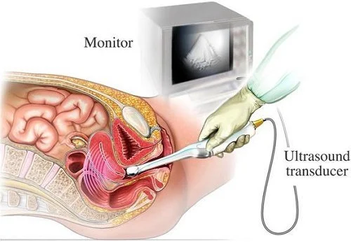 siêu âm đầu dò có phát hiện ra thai ngoài tử cung hay không